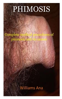 Phimosis: A complete medical procedure of phimosis and its causes