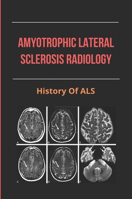 Amyotrophic Lateral Sclerosis Radiology: History Of ALS: Amyotrophic Lateral Sclerosis Symptoms